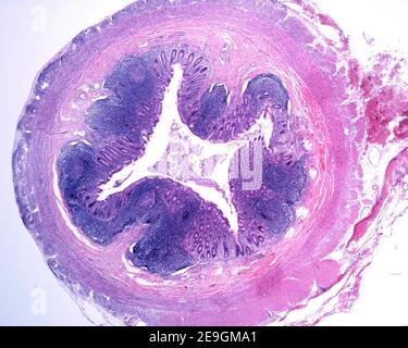 Querschnitt eines menschlichen Vermiform-Anhangs. Die Wand wird durch das Vorhandensein zahlreicher lymphoider Follikel sowohl in der Schleimhaut als auch in der Submukosalage verdickt Stockfoto