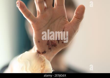 Abschürfungen an der Handfläche der rechten Hand eines erwachsenen Mannes. Behandlung zu Hause. Entfernen der Bandagen. Nahaufnahme. Stockfoto