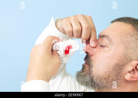 Mann, der an Nasenbluten oder Epistaxis leidet und Papiergewebe verwendet, um Blutungen zu stoppen. Gesundheitskonzept Stockfoto