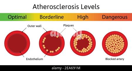 Atherosklerose Ebenen. Verschiedene Stadien der Arterienverkalkung. Atherosklerotische Plaque. Arterienanatomie. Medizinische Vektordarstellung Stock Vektor