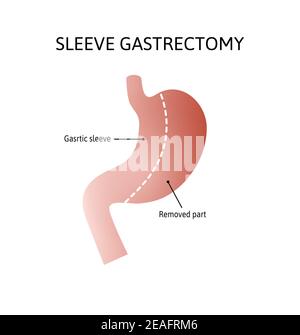 Vertical Sleeve Gastrektomie. Menschlicher Magen isoliert auf weißem Hintergrund. Abnahme des Magenvolumens. vektor-Illustration mit Linien markiert. Stock Vektor