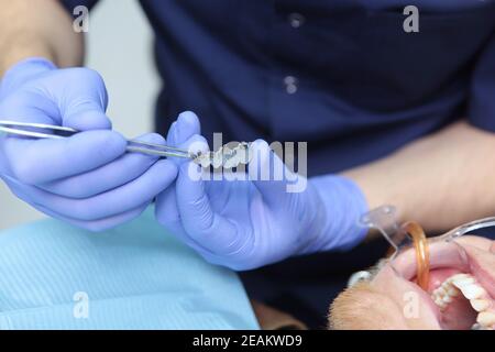 Installation von Zahnspangen zur Ausrichtung des Gebisses oder Biss. Neue Zahnspange in den Händen eines Zahnarztes. Nicht erkennbare Person. Hände in Schutzhandschuhen. Das Konzept der Gesundheit. Stockfoto