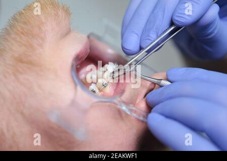 Die Installation von Zahnspangen. Ausrichtung des Gebisses oder Bisses. Pinzette in den Händen eines Arztes. Das Konzept von Schönheit und Gesundheit. Makroaufnahme der Mundhöhle. Stockfoto