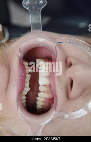 Dilator für die Mundhöhle. Vorbereitung der Mundhöhle des Patienten für die Installation von Zahnspangen. Makrofoto. Nicht erkennbare Person. Gesundheitskonzept. Vertikales Foto. Stockfoto