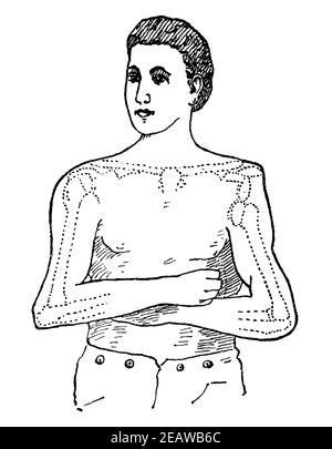 Schematische Darstellung der Dislokation des Schultergelenks. Illustration des 19th. Jahrhunderts. Deutschland. Weißer Hintergrund. Stockfoto