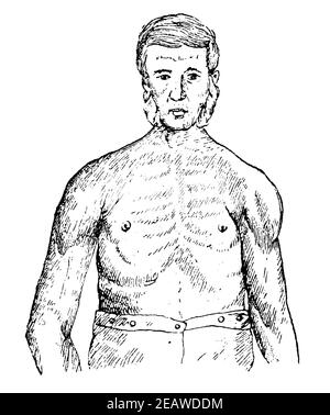 Muskelparalyse des Oberkörpers eines Arbeiters aufgrund chronischer Quecksilbervergiftung. Vorderansicht. Illustration des 19th. Jahrhunderts. Deutschland. Weißer Hintergrund. Stockfoto