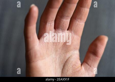 Keratosis pilaris an den Händen verursacht sehr trockene Haut während der Wintersaison. Handekzem braucht viel Pflege. Stockfoto
