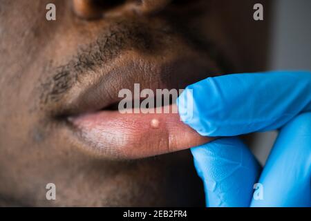 Wunde Herpes Lippen Behandlung Auf Männliches Gesicht Stockfoto