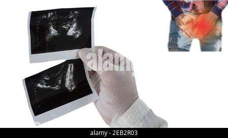 Prostata-Adenom bei Männern auf Ultraschall-Scan isoliert auf weißen Kopieraum, Schmerzen im Urogenitalkanal bei einem Mann, analysiert Urologe Prostata-Erkrankung. Stockfoto