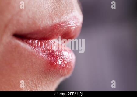 Makrofotografie von weiblichen Lippen mit Herpes. Noppen an der Unterlippe. Erkältungsvirus Herpes. Konzept des Gesundheitswesens Stockfoto