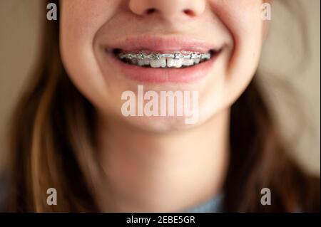 Nahaufnahme von Zahnspangen auf den Zähnen eines Teenagers Gegen leere Wand Stockfoto