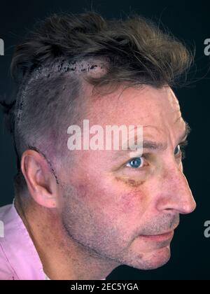 Mann mit rasierten Kopf enthüllt gehefteten Einschnitt nach einer Gehirnoperation Stockfoto