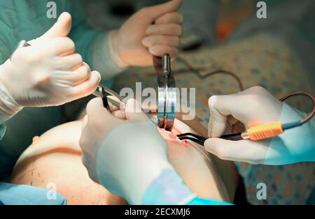 Team-Chirurgen führen eine Operation, gutaussehende Arzt mittleren Alters schaut auf Kamera, in einem modernen Operationssaal Stockfoto