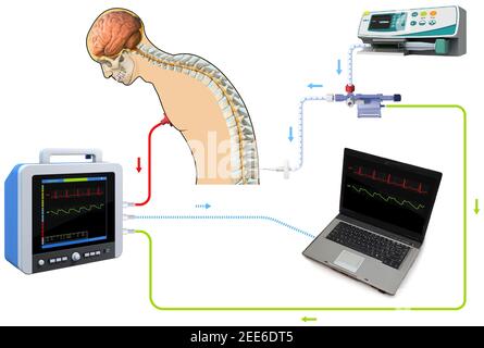 Lumbalpunktion Spinalzapfkanal diagnostische sammeln Probe Patient behandeln MS-Tumor, 3D Rendering und 2D Grafik Stockfoto
