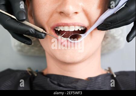 Draufsicht auf den Mund des Mädchens im Zahnarztstuhl. Abgeschnittene Zahnarzthände in schwarzen Gummihandschuhen, die Zahnspangen an den Zähnen des Patienten mit zahnmedizinischen Werkzeugen aus Stahl überprüfen. Keramik- und Metallhalterungen. Makrofotografie Stockfoto