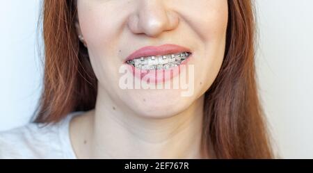 Zahnspange im lächelnden Mund eines Mädchens. Nahaufnahmen von Zähnen und Lippen. Glatte Zähne von Zahnspangen. An den Zähnen von elastischen Bändern zum Festziehen der Zähne Stockfoto