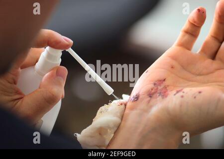 Abschürfungen an der Handfläche und Kratzer am rechten Arm eines erwachsenen Mannes. Behandlung von Wunden und Abschürfungen mit einem Antiseptikum. Nahaufnahme. Stockfoto