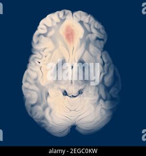 Axialer Abschnitt des Gehirns mit EINEM geschwollenen rechten frontalen Lobe Hämatom Stockfoto