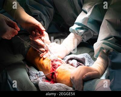 In einem Operationssaal wird eine Unterschenkelamputation durchgeführt Stockfoto