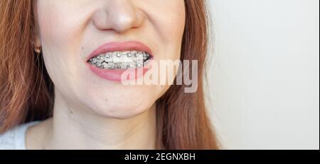 Zahnspange im lächelnden Mund eines Mädchens. Nahaufnahmen von Zähnen und Lippen. Glatte Zähne von Zahnspangen. An den Zähnen von elastischen Bändern zum Festziehen der Zähne Stockfoto