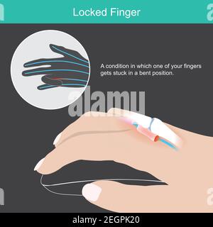 Gesperrter Finger. Dieses Bild zeigt den Menschen von Hand und Probe, die verursacht werden, von denen einer Ihrer Finger in einer verbogenen Position feststeckt, die oft als verriegelte Fi bezeichnet wird Stock Vektor