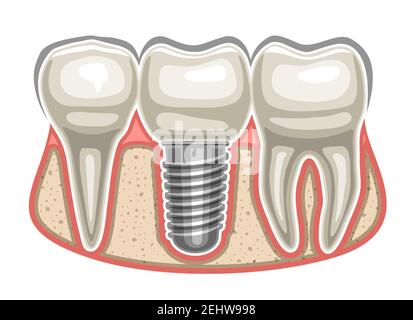 Vektor-Illustration von Dental Implant, 3 menschliche Zähne in einer Reihe und keramischen künstlichen Zahn mit Schraube in Knochen Kiefer, dekorative Beschilderung für professionelle Stock Vektor