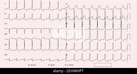 EKG-Beispiel für einen pathologischen 12-Kanal-Rhythmus, supraventrikulärer vorzeitiger Herzschlag Stockfoto