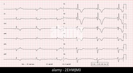 EKG-Beispiel für einen pathologischen 12-Kanal-Rhythmus, Vorhofflimmern mit Gesamtblock Stockfoto