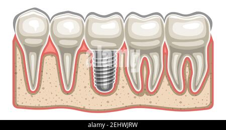 Vektor-Illustration von Dental Implant, 5 menschliche Zähne in einer Reihe und Keramik-Kunstzahn mit Schraube in Knochen Kiefer, dekorative horizontale Aufkleber für p Stock Vektor