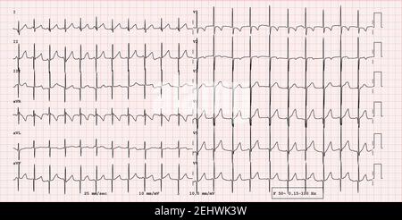 EKG-Beispiel für einen normalen 12-Kanal-Sinusrhythmus bei Kindern Patient Stockfoto