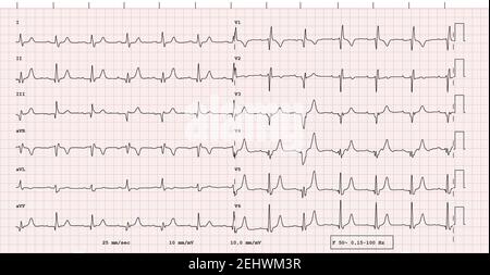 EKG Beispiel F r 12 Kanal Rhythmus Linksschenkelblock Reale ekg-beispiel-f-r-12-kanal-rhythmus-linksschenkelblock-reale