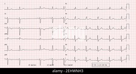 EKG Beispiel für einen pathologischen 12-Kanal-Rhythmus, Vorhofflimmern Stockfoto