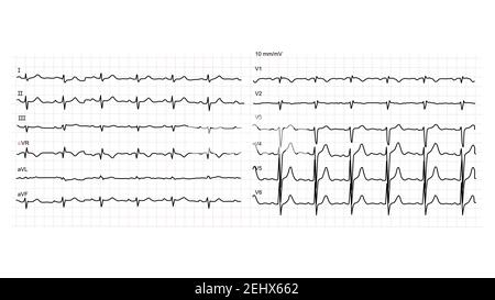 Abbildung eines normalen menschlichen Elektrokardiogramms oder EKG auf weißem Hintergrund. Vektorgrafik. Stock Vektor