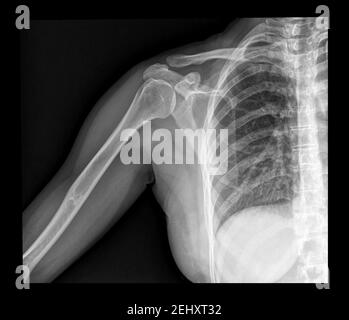 Röntgenaufnahme der Schulter mit akromioklavikulärer Verstauchung, Sportverletzungen Stockfoto