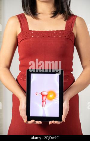 Frau hält den Bildschirm mit Eierstockfibrom Stockfoto