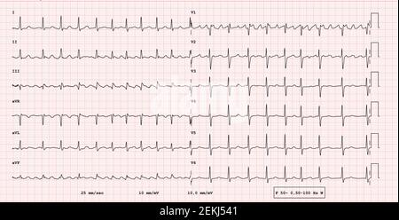 EKG-Beispiel für einen pathologischen 12-Kanal-Rhythmus, Vorhofflattern Stockfoto