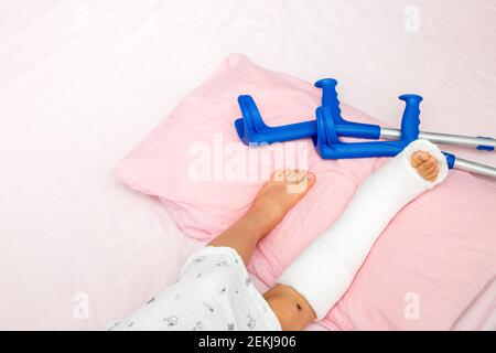 Knochenbrüche am Bein eines Kindes. Kinderbein in einem Cast auf dem Bett mit Krücken in der Nähe.Draufsicht Stockfoto