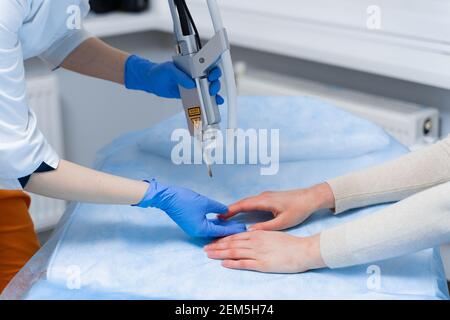 Laser-Behandlung von Onychomykose. Pilzinfektion auf den Händen eines jungen Mädchens in der medizinischen Klinik. Stockfoto