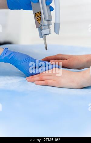 Laser-Behandlung von Onychomykose. Pilzinfektion auf den Händen eines jungen Mädchens in der medizinischen Klinik. Stockfoto