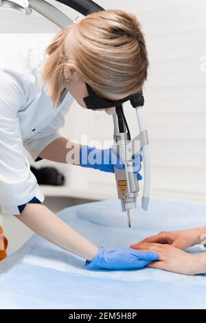 Laser-Behandlung von Onychomykose. Pilzinfektion auf den Händen eines jungen Mädchens in der medizinischen Klinik. Stockfoto