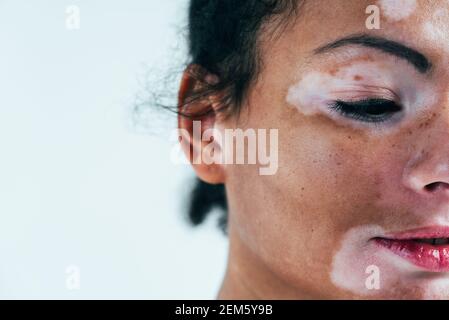 Schöne Frau mit Vitiligo Haut posiert im Studio. Konzept über Körper-Positivität und Selbstakzeptanz Stockfoto