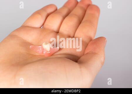 Künstliche Zahnprothese in der Hand einer Person. Einzelne herausnehmbare Prothese, um einen echten Zahn zu ersetzen, Stockfoto