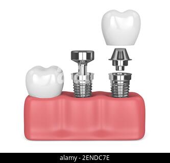 3D Zahnfleischrendering mit implantierender Zahnprozedur. Implantationskonzept Stockfoto