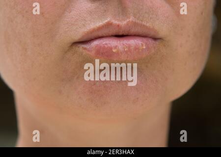 In der Nähe der weiblichen Lippen Herpes Krankheit leiden. Stockfoto