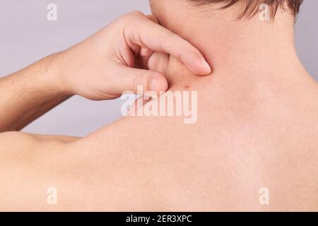 kaukasischen männlichen mit Hautproblemen. Akne-Check. Hautpflege-Konzept Stockfoto