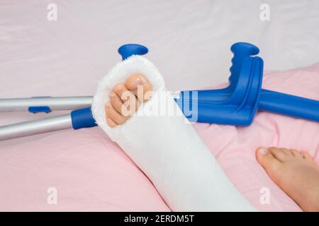 Nahaufnahme von Knochenbrüchen am Bein eines Kindes. Kinderbein in einem Cast auf dem Bett mit Krücken in der Nähe. Stockfoto