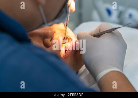 Zahnarzt mit Zahnsonde und Scaler während der zahnärztlichen Untersuchung Stockfoto