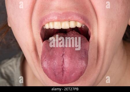 Stomatitis Entzündung der Zunge, Krebs der Zunge Stockfoto