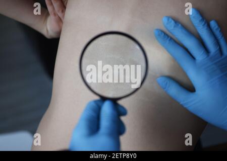 Arzt untersucht Dehnungsstreifen auf Patienten zurück mit Lupe Nahaufnahme Stockfoto