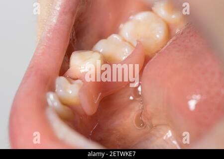 Künstliche, herausnehmbare Zahnprothese im Mund des Patienten. Eingefügt eine einsame gefälschte Molar in der Zahnmedizin. Stockfoto